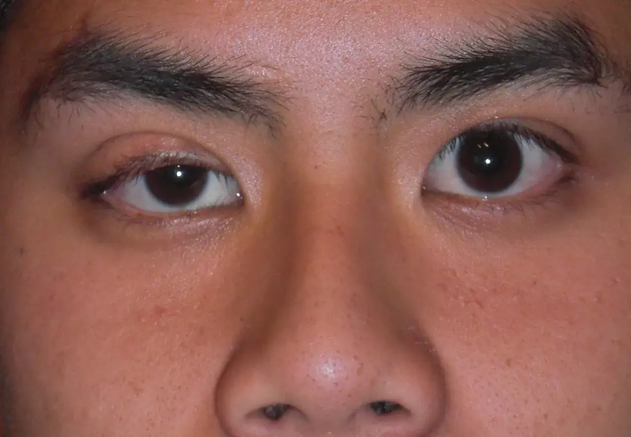 Primer plano de unos ojos y nariz. El ojo izquierdo parece entrecerrado, como si durmiera con los ojos abiertos.